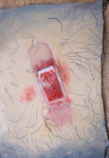 Rupture